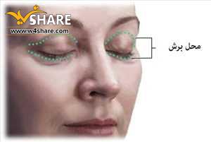 جراحی پلک